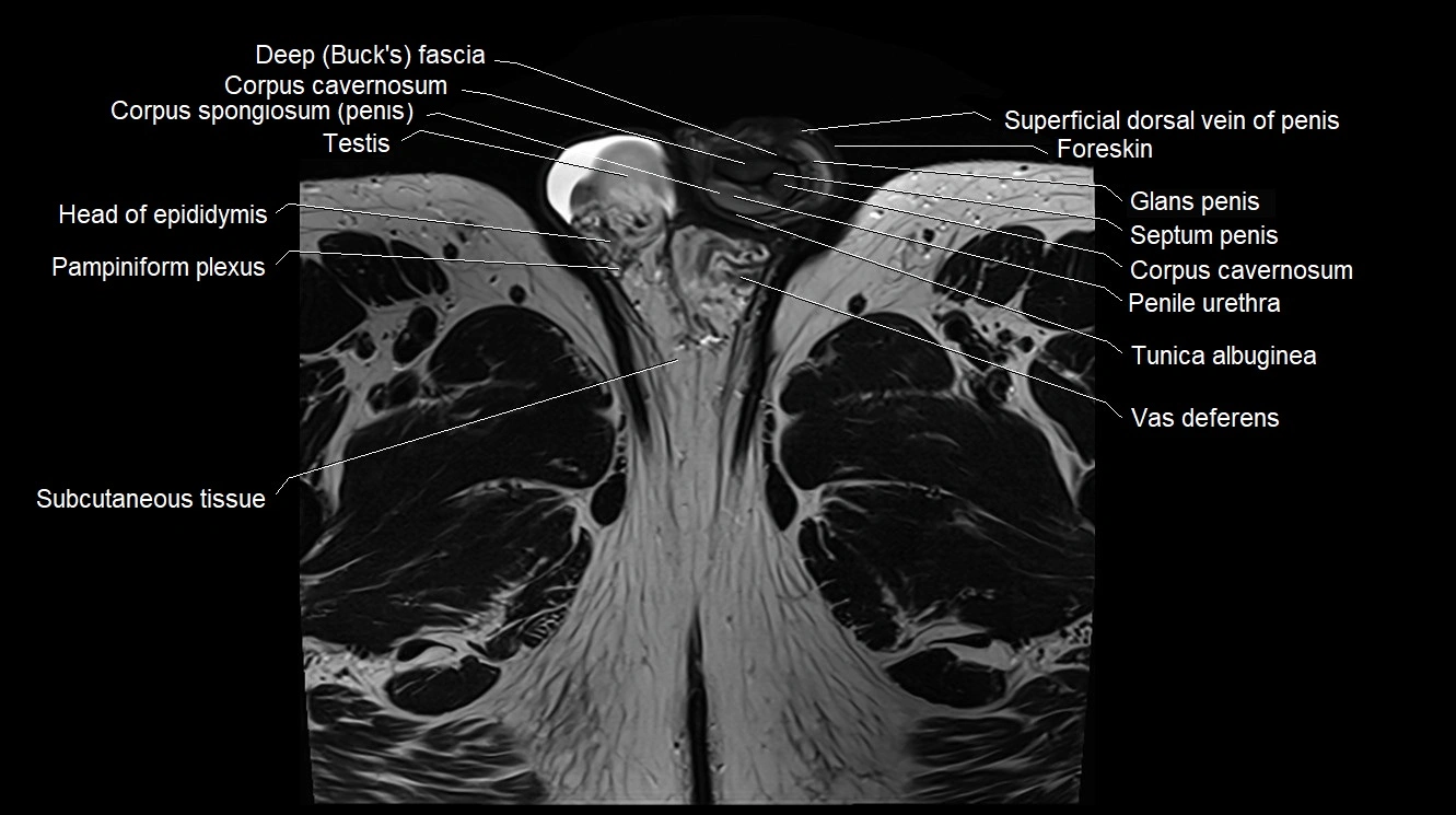 MRI 3T scrotum and penis axial cross sectional anatomy image 28.webp
